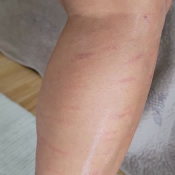 Aris Ezgi Doğan Polikliniği Çukurambar'da Yaşanan Estetik Ve Epilasyon Hizmetleri Şikayeti