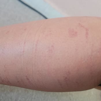 Aris Ezgi Doğan Polikliniği Çukurambar'da Yaşanan Estetik Ve Epilasyon Hizmetleri Şikayeti