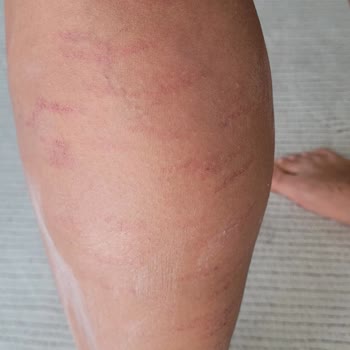 Aris Ezgi Doğan Polikliniği Çukurambar'da Yaşanan Estetik Ve Epilasyon Hizmetleri Şikayeti