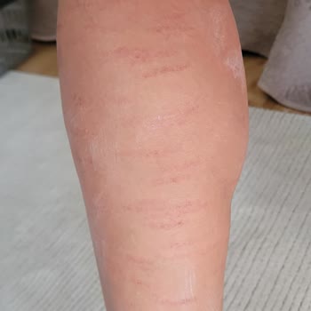 Aris Ezgi Doğan Polikliniği Çukurambar'da Yaşanan Estetik Ve Epilasyon Hizmetleri Şikayeti