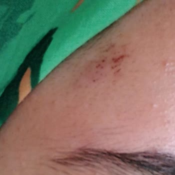 Hazal Babalık Beauty Lazer Epilasyon Sorunu