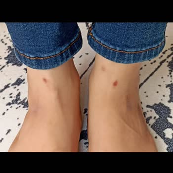 Hazal Babalık Beauty Lazer Epilasyon Sorunu