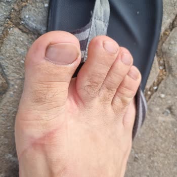 Ceyo Terlikler Parmak Arası Rahatsızlığı