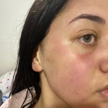 Yves Rocher Ürünü Yüzümde Kimyasal Yanık Oluşturdu