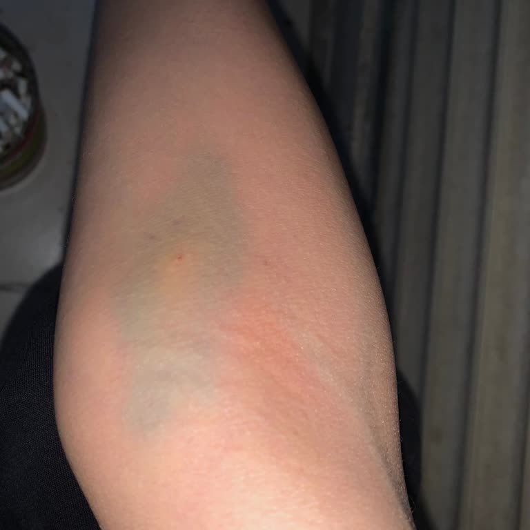 Gemlik Devlet Hastanesi Kan Alan Hemşirelerin Vurdumduymazlığı