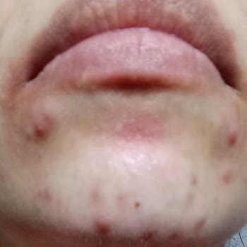 La Roche Effaclar Yüzümü Mahvetti