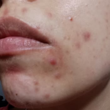 La Roche Effaclar Yüzümü Mahvetti