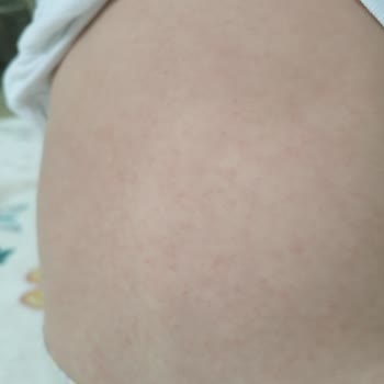 Glaxo Smith Kline Calgel 20 Mg Alerji Yaptı!