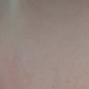 Sebamed Alerji Ve Döküntü Yaptı