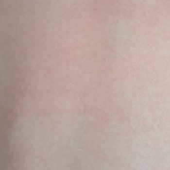 Sebamed Alerji Ve Döküntü Yaptı