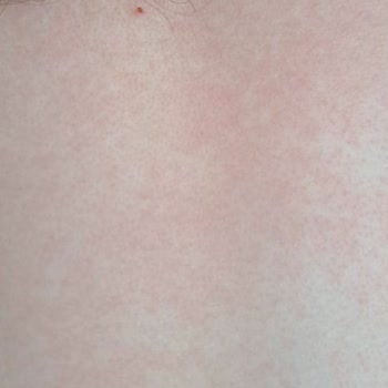 Sebamed Alerji Ve Döküntü Yaptı