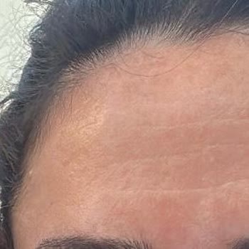 Yves Rocher Yüzümde Leke Oluşturdu