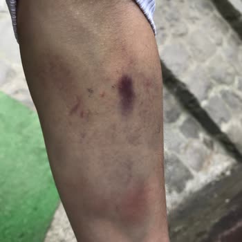 Kaçkar Devlet Hastanesi Sağlık Personelinin Yetersizliği: Damar Yolu Açma Kabusu