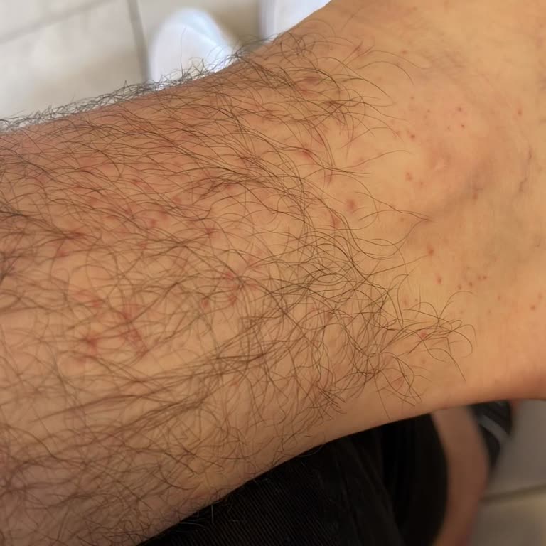 Wartner Mantar İlacı Yan Etki