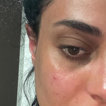 Loreal Ürünü Yüzümde Yanma Ve Tahrişe Sebep Oldu