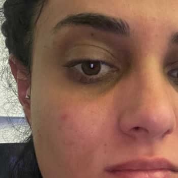 Loreal Ürünü Yüzümde Yanma Ve Tahrişe Sebep Oldu