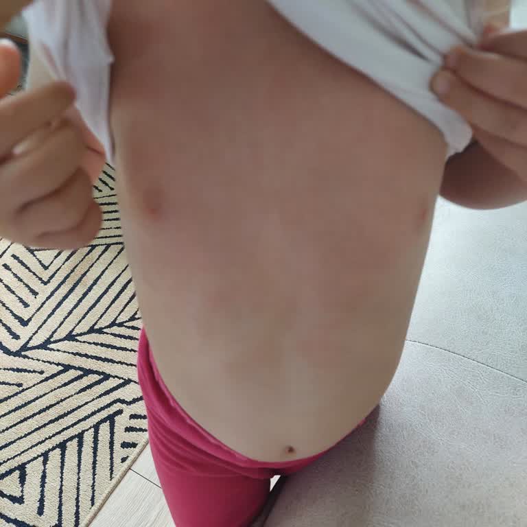 Mustela Göğüs Balsam Alerji Yaptı