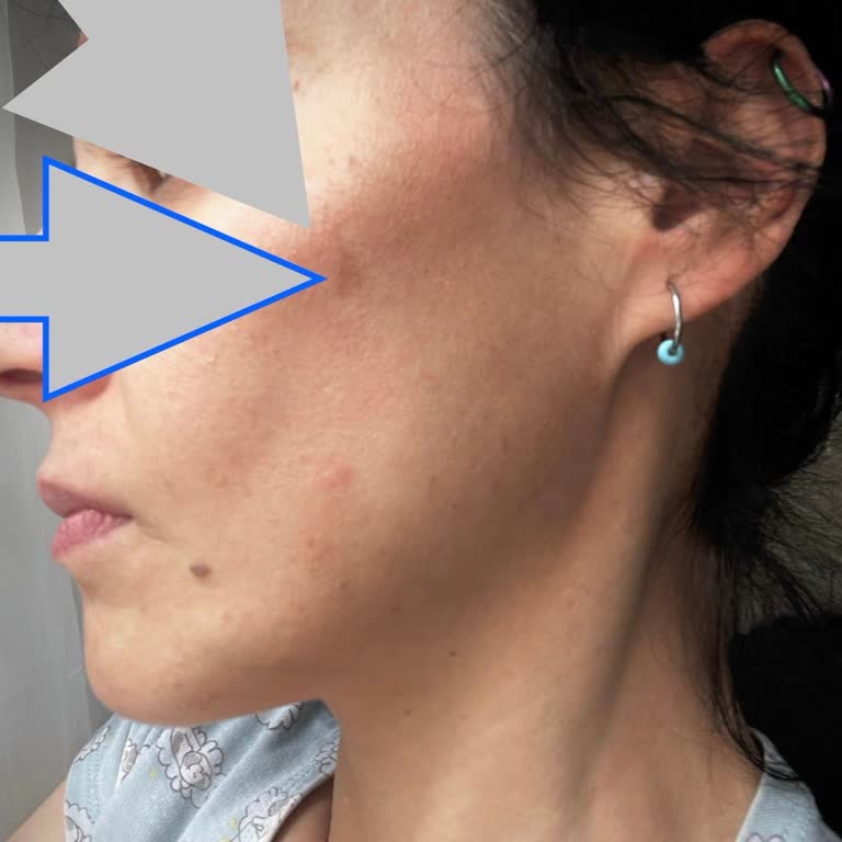 Nara Clinique Yanlış Dolgu Yüzünden Yüzümüm Şekli Değişti Mahvoldum