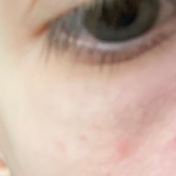 Otacı Göz Çevresi Kremi Kabarcıklar Ve Kızarıklık Yaptı