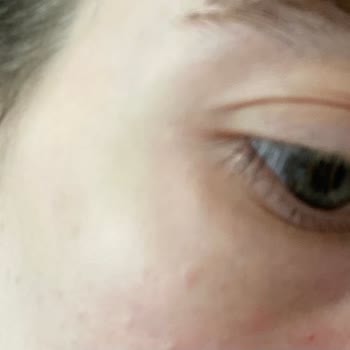 Otacı Göz Çevresi Kremi Kabarcıklar Ve Kızarıklık Yaptı