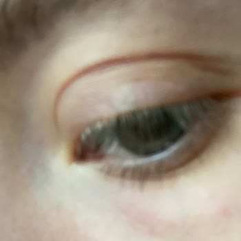 Otacı Göz Çevresi Kremi Kabarcıklar Ve Kızarıklık Yaptı