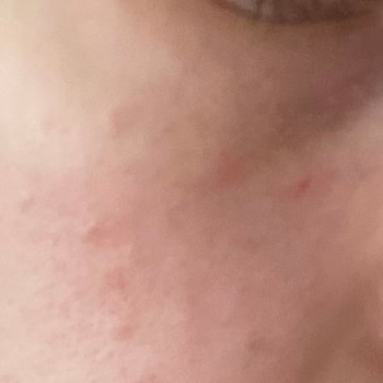 Otacı Göz Çevresi Kremi Kabarcıklar Ve Kızarıklık Yaptı