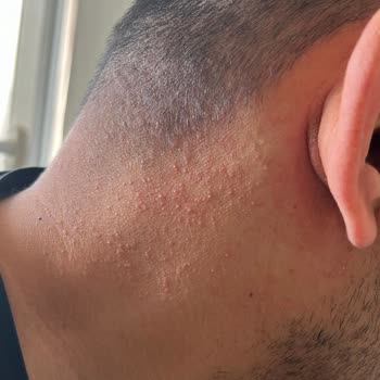 Sivilce = Yves Rocher Serum