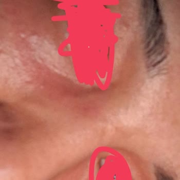 BİM'den Aldığım Göz Altı Serumu Alerjiye Sebep Oldu