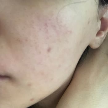 Claderm Kil Yüz Maskesi