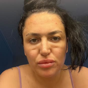 Sena Medikal Estetik Gözaltı Işık Dolgusu Sorunu