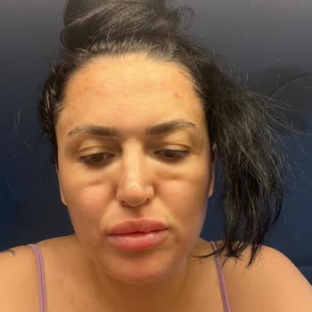 Sena Medikal Estetik Gözaltı Işık Dolgusu Sorunu