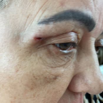 Ataköy Hastanesi Göz Kapak Ameliyatı