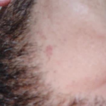 İstanbul Çekmeköy Çamlık Tıp Merkezi Lazer Sorunu