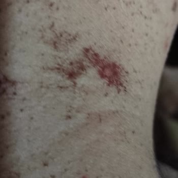 İstanbul Çekmeköy Çamlık Tıp Merkezi Lazer Sorunu