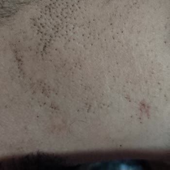 İstanbul Çekmeköy Çamlık Tıp Merkezi Lazer Sorunu