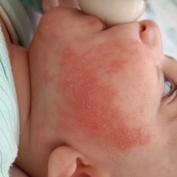 Aptamil Bebeklerde Alerji Yapıyor