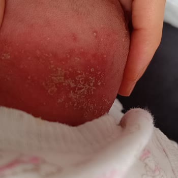 Aptamil Bebeklerde Alerji Yapıyor