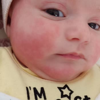 Aptamil Bebeklerde Alerji Yapıyor