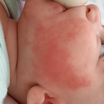 Aptamil Bebeklerde Alerji Yapıyor