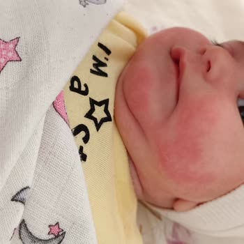 Aptamil Bebeklerde Alerji Yapıyor