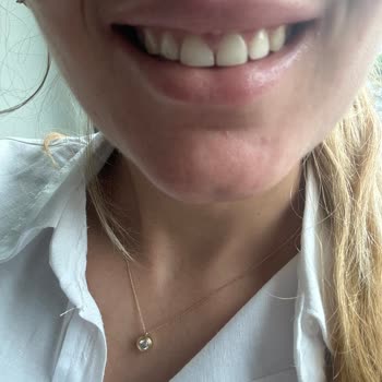 Dentevim Ağız ve Diş Sağlığı Polikliniği Dolgu Düşmesi Ve Verilen Sözün Tutulmaması