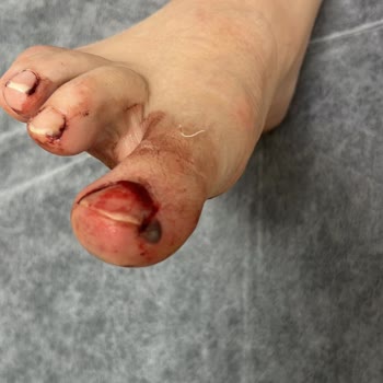 Lykia World Antalya Otelin Sorumluluğundan Dolayı Kaza Yaşadık