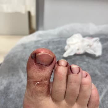 Lykia World Antalya Otelin Sorumluluğundan Dolayı Kaza Yaşadık