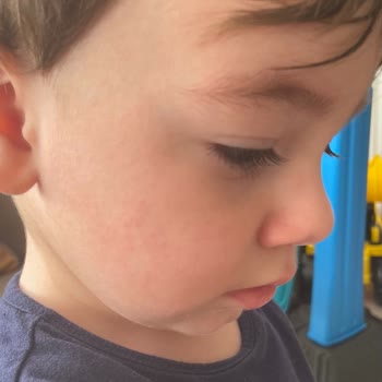 Abdi İbrahim Grintuss Pediatrik Şurup Alerjisi