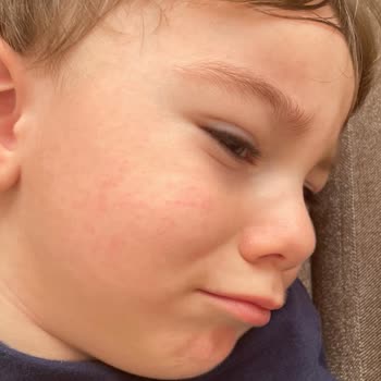 Abdi İbrahim Grintuss Pediatrik Şurup Alerjisi