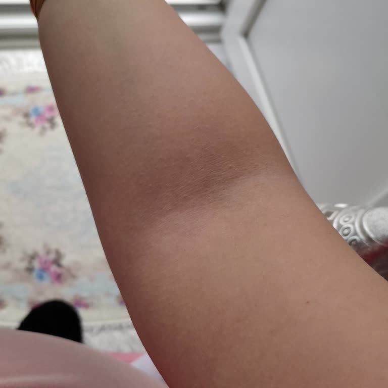 Rossmann Isana Ürea Krem Kaşıntı Yapıyor