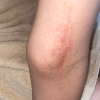 La Joie Beauty & Aesthetic La Joie Güzellik Mikrop Kaptım