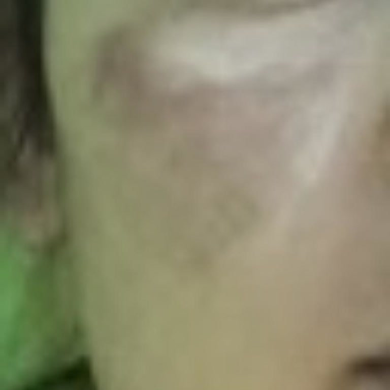 Defne Estetik IPL Lazer İşlemi