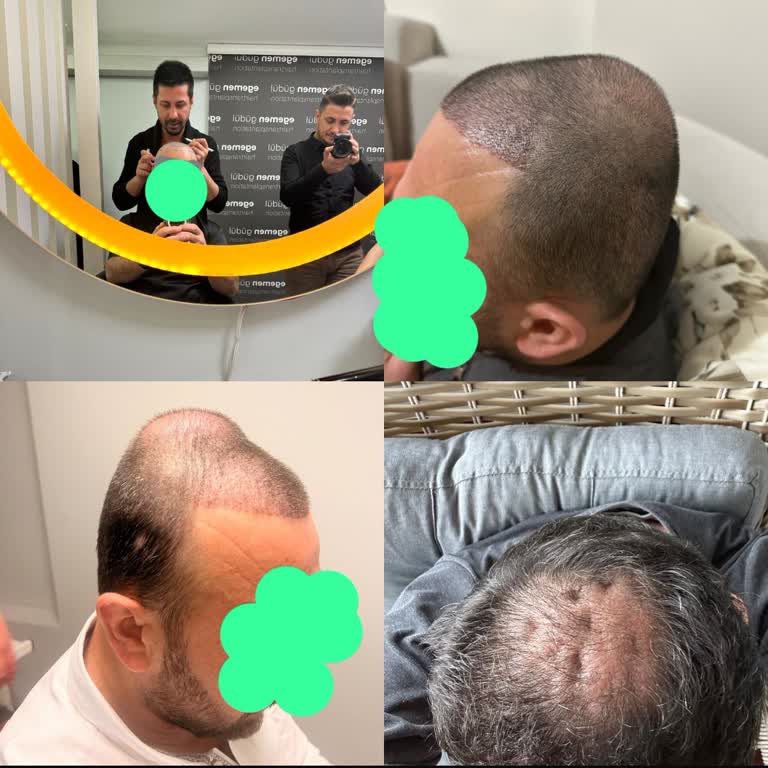 Egemen Güdül (Hairclinic) Saç Ekimi Şikayeti