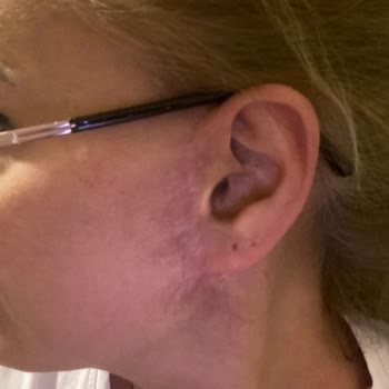 Gözde Herşey - Dr. Semih Doğan Estetik Müdahale Deneyimim